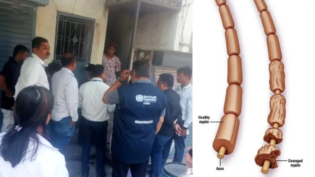 Guillain-Barré Syndrome