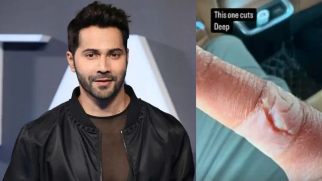 Varun Dhawan Injured